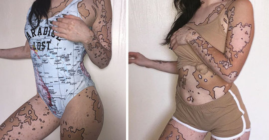  Woman Once Bullied For Vitiligo Now Uses The Unique Markings To Create Amazing Art 