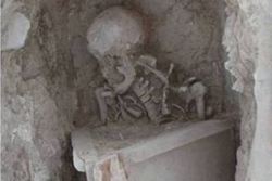 Calcified Teratoma Found In Pelvis Of Roman Woman. Archaeologists Working In The