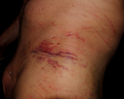 My  “battle marks”, a couple of days later. I wonder, will I find another dom to let me experience this again?