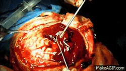 emtgio:  Today’s (QUICK) lesson, we cover subdural hematoma! So basically, its a collection of blood on top of the brain. As for the nice little GIF above, that entire jello-like goo is one huge blood clot! Which interestingly enough was caused by a