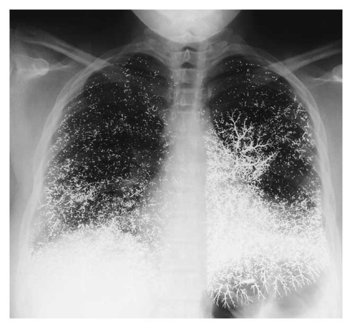 erythr0psia:  Woman committed suicide by injecting herself with Mercury, which later collected in her lungs. 