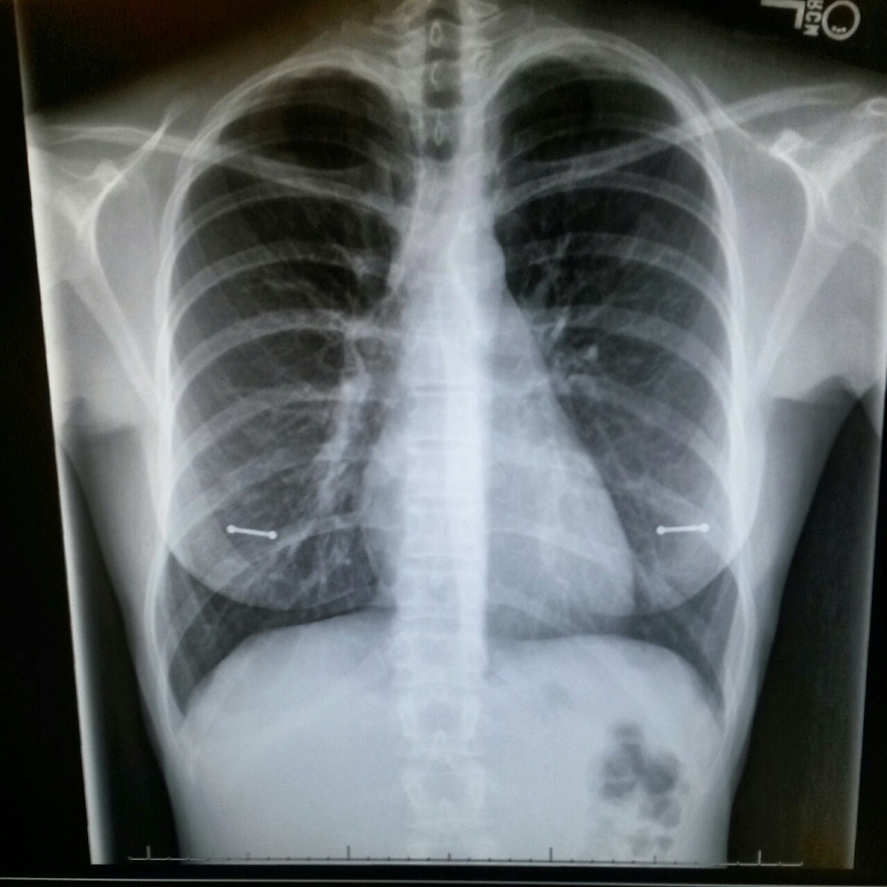meeowth-thats-right:I think I scared the radiologist