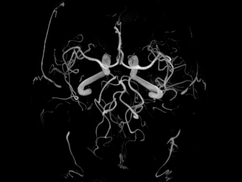 medicalschool: Cerebral angiography is a procedure that uses a special dye (contrast material) and x