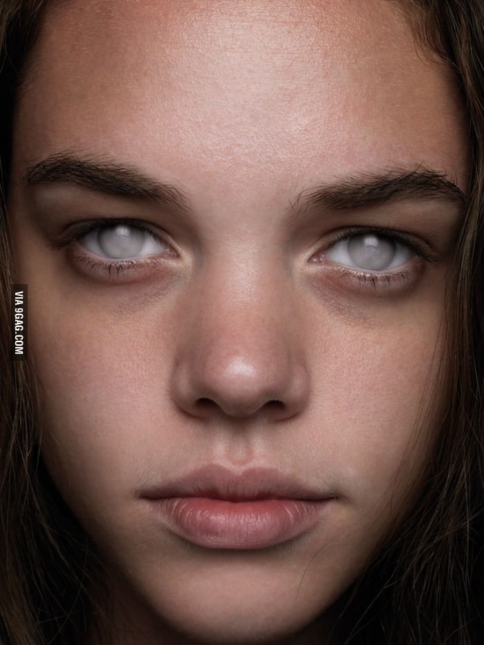 ragecomics4you:  This is what blind eyes look like, mostly (when cause is not injury)http://ragecomics4you.tumblr.com