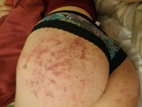 XXX My butt bruises beautifully. photo