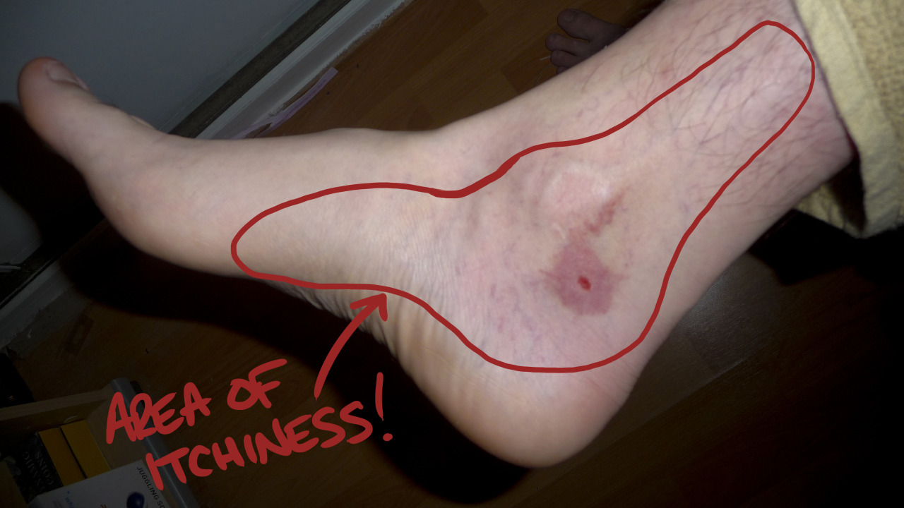 In need of a little help!
So, I got bitten by something a couple of nights ago and this is the result :| I’m wondering if anyone out there in tumblrland can help identify what the fuck bit me as it’s itchy as fuck and refuses to heal no matter how...