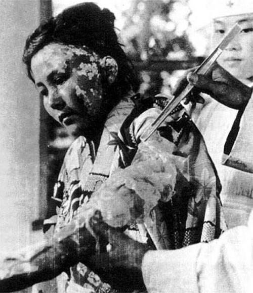 22-year old victim Toyoko Kugata being treated at the Hiroshima Red Cross Hospital after the U. S. 