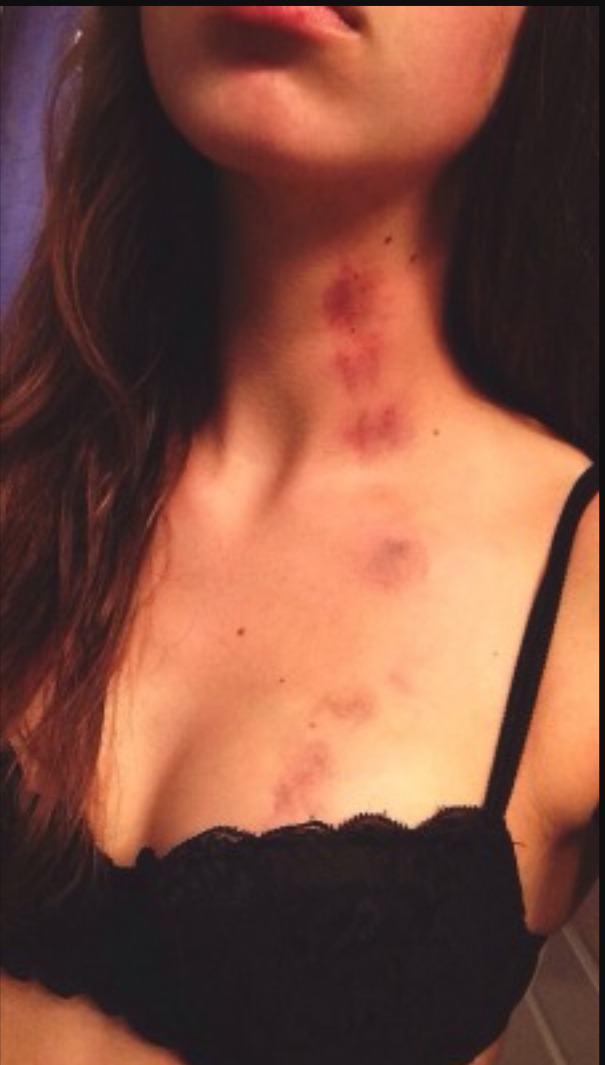 if-only-y0uknew on Tumblr: Hickeys 😍