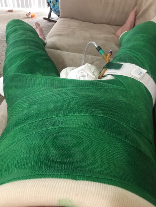 Stuck in a double hipspica cast! It is really comfy except for the sweating part of it