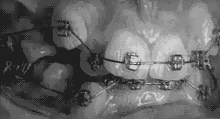 gif-not-jif:  How do braces work the gifs blog 