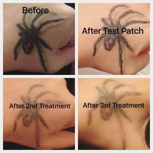 Tattoo removal by me @laseredbeauty appointments adult photos