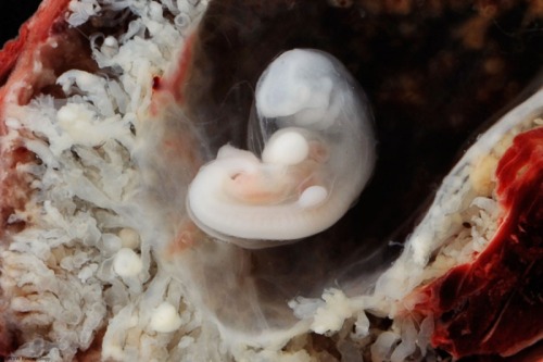 moshita: 5mm Embryo appears as Carnegie Stage 13 from ectopic pregnancy. Embryo is enclosed in amnio