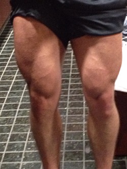 First Time Ever Havin Leg Veins. Exciting.