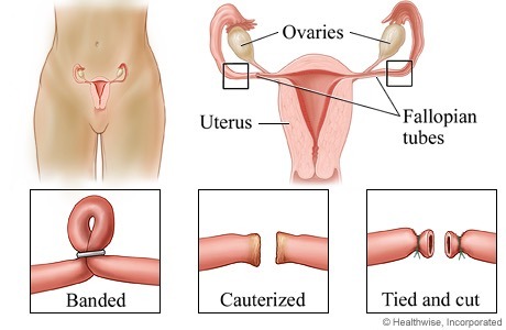 themidwifeisin:  Anonymous asked:After getting tubal ligation what happens to your