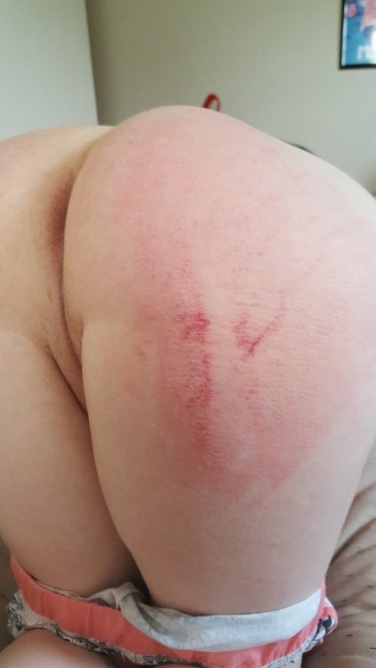 lil-uni:My butt after a paddling~I love bruises <3