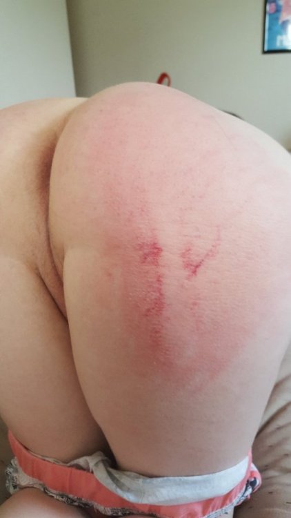 lil-uni:  My butt after a paddling~I love bruises <3