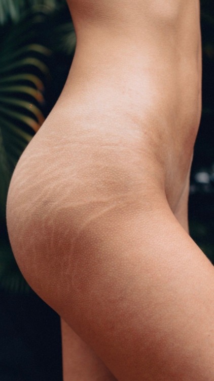 :Stretch marks are natural ornaments to the body. Beautiful 😍 