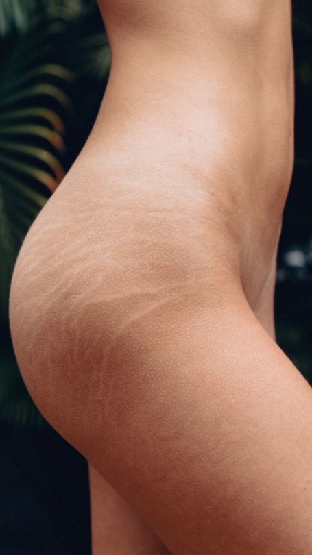 Porn photo :Stretch marks are natural ornaments to the