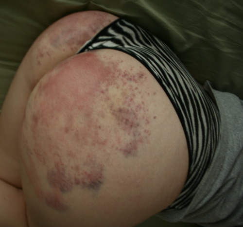 slide1mile6inches:Early morning bruises 