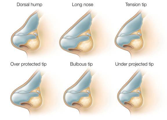 Asian nose rhinoplasty