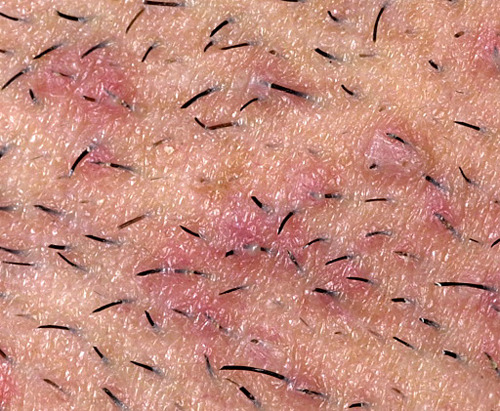 queennubiana:  monaeism:  queennubiana:  Guys and girls: If you shave and get ingrown