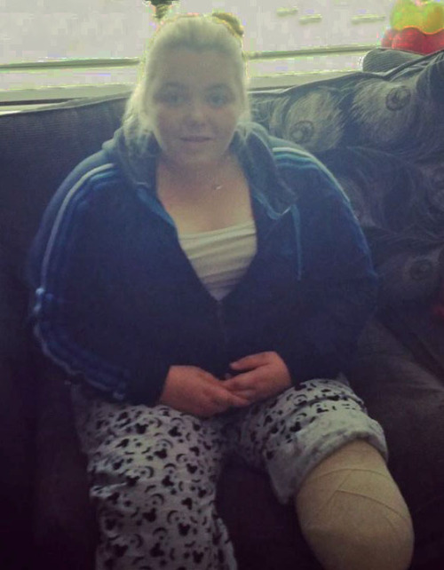 British lass who lost her leg below the knee due to an infection