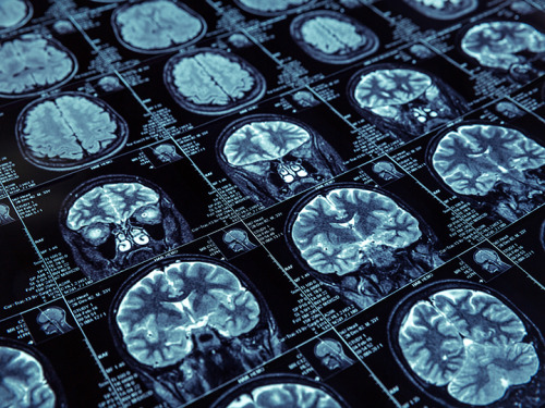 themedicalstate: Cognitive impairment from severe COVID-19 equivalent to 20 years of ageingCognitive