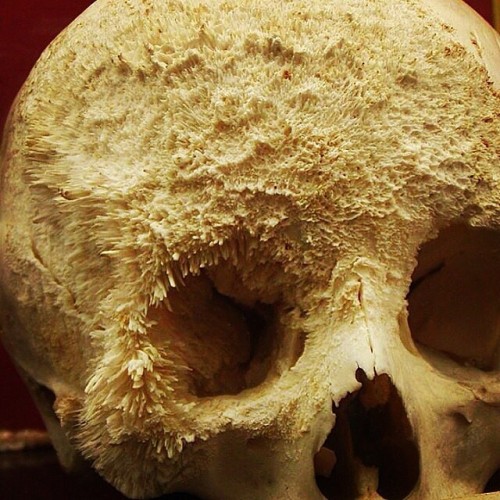 psychopathicneighbor:Bone cancer enveloping a human skull.