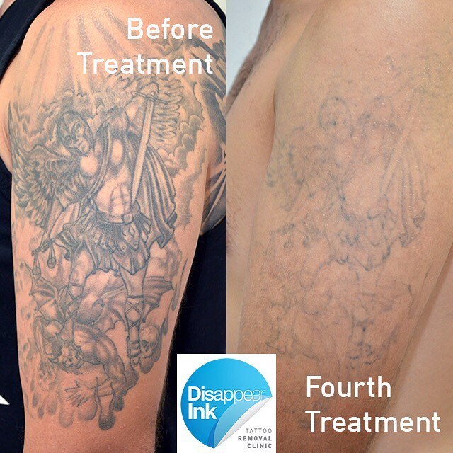 Sydney Laser Tattoo Removal — Here is a huge bicep tattoo that is making  way for...