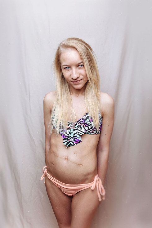 talapishka:    A Photographer Started A Photo Project To Show That Women With Cystic