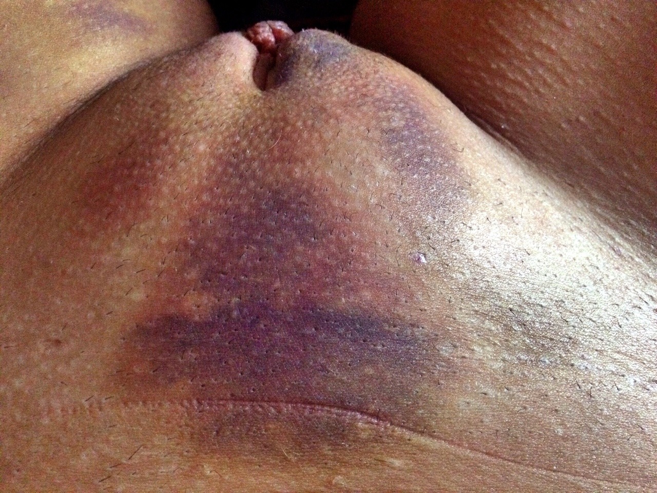 kittenwithawhip69:  Day 1 through to Day 6..  I remain fascinated by how bruises
