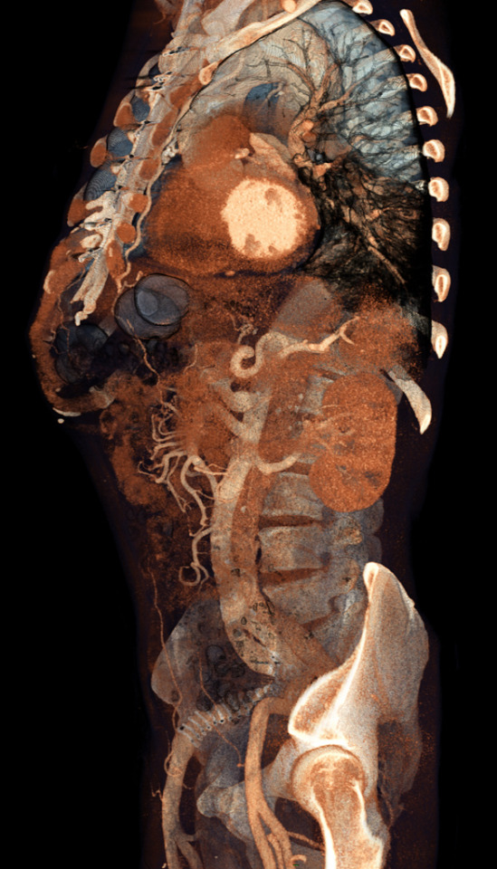 Volume Rendering CT Scans By Voxel123