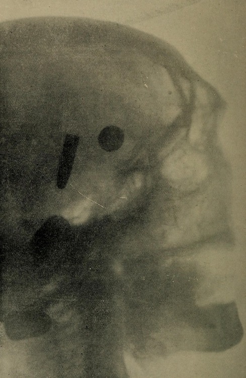Three Bullets in the Head of a Cadaver, The Röntgen Rays in Medical Work, 1899