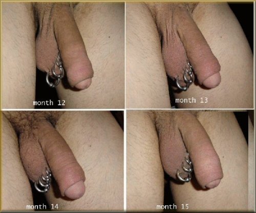 ban-ric:  (These pictures aren’t mine, here is the source)If you’re ever feeling disappointed about being circumcised, you can always restore your foreskin like the man in the pictures above did. It only took him 2 years to achieve the last picture,