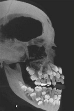 lebritanyarmor:  sixpenceee:  Hyperdontia