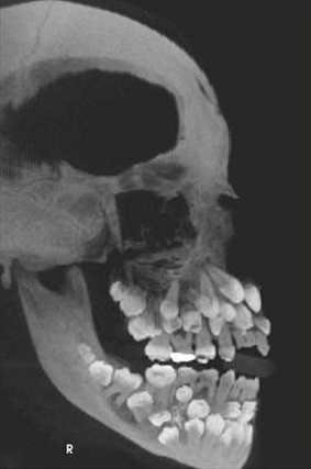 Porn Pics lebritanyarmor:  sixpenceee:  Hyperdontia