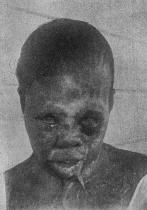 Bad Blood in Tuskegee — The Tuskegee Syphilis StudyBack in the day syphilis was a very deadly 