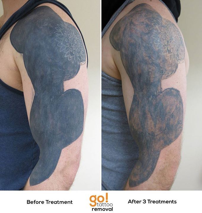 GO! Tattoo Removal — Another large scale black-out piece we're helping...