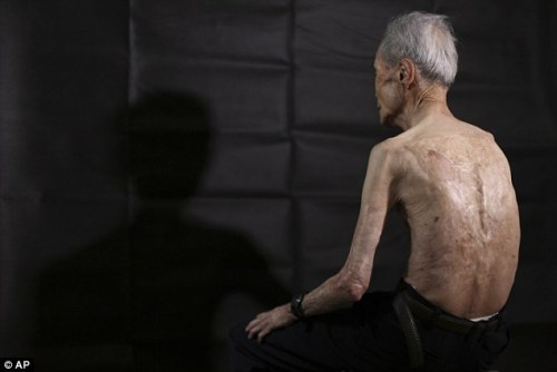 sixpenceee:  Atomic Bomb Survivor: Sumitery Taniguchi The frail 86-year-old body of Sumitery Taniguchi is a web of scars, that have criss-crossed his skin for 70 years. The elderly man was one of the many tens of thousands of victims of the atomic blast