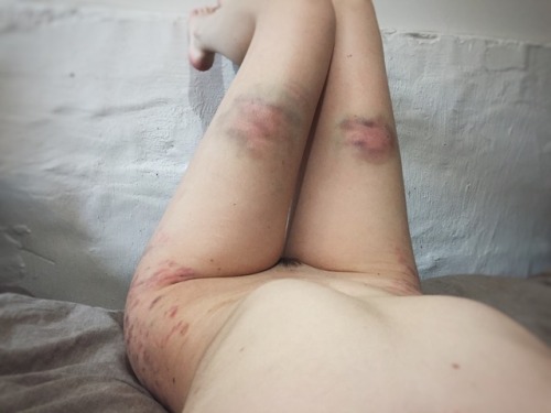 handprints-and-hickies: defiantly-yourss: Reoccurring theme: me bruised and crying. ugh i want someo