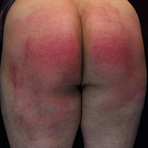 How his butt looks after a trip to the woodshed. Real Domestic Discipline.https://domesticdiscipline