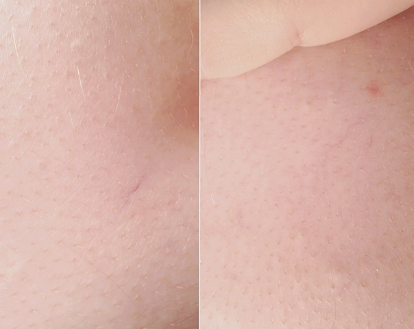 bloodyamy:  my bf’s skin 