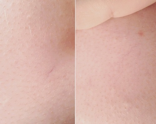 bloodyamy:  my bf’s skin 