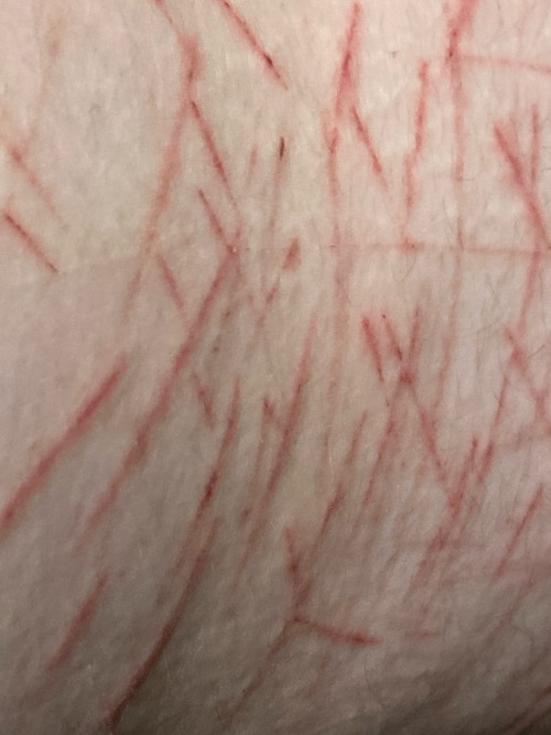 Tw Self H@rm Sc@rs