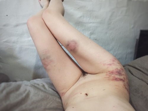 handprints-and-hickies: defiantly-yourss: Reoccurring theme: me bruised and crying. ugh i want someo