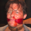 markhoffmans600ccbreastimplants
