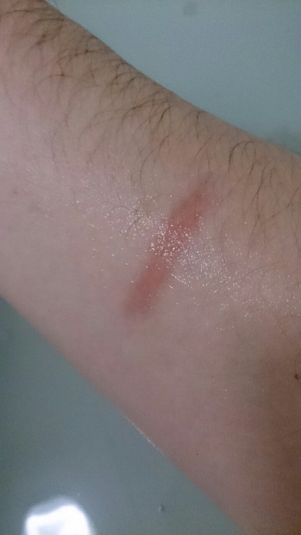 Scarred for life….pesky woodburners.