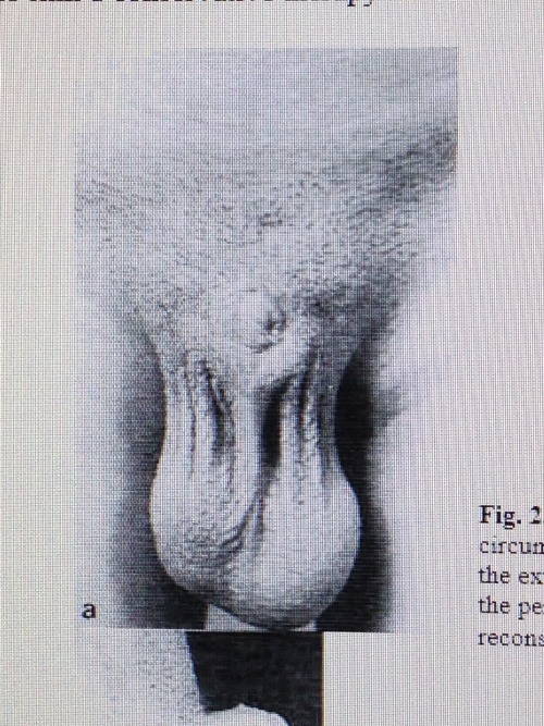 Porn Pics penectomies: Total loss of penis due to botched