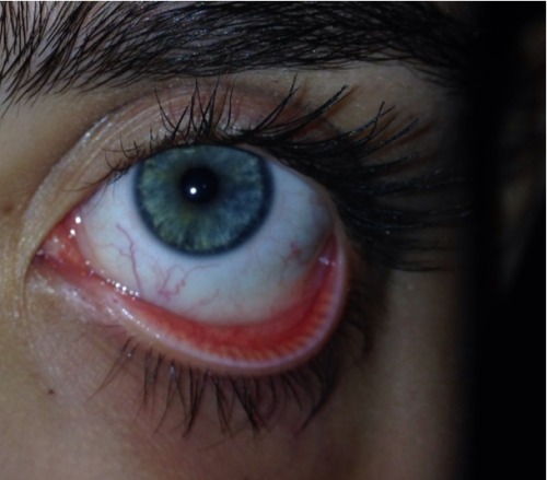 under-a-r0ck: My eye looks misshapen
