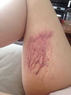 pervy-doll:  Turns out I bruise really, really